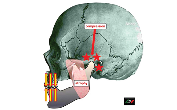 Fig. 1 In mancanza dei denti posteriori, le articolazioni temporomandibolari possono andare incontro a compressione e i muscoli elevatori, mancando di funzione, vanno incontro a progressiva atrofia.