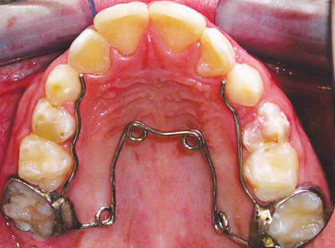 Fig. 13 Quadhelix saldato a bande sui sesti con estensione fino al canino, apparecchio molto duttile che oltre a mantenere lo spazio può essere utilizzato per rafforzare l’ancoraggio e dare espansione dento-alveolare.