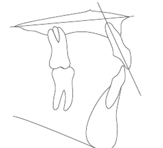 Fig. 20 Valori di riferimento per l’angolo tra l’incisivo superiore e il piano palatale: più aperto è l’angolo, maggiore è la protrusione.