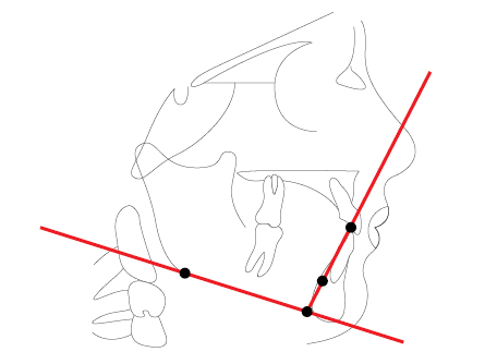 Fig. 21 Angolo tra l’asse dell’incisivo inferiore e il piano mandibolare: più aperto è l’angolo, maggiore è il sostegno al labbro inferiore.