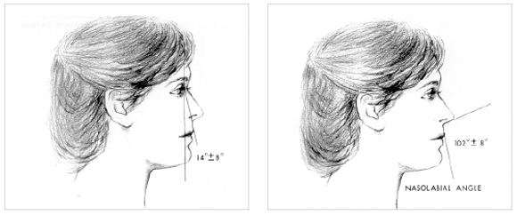 Figg. 26a e 26b Effetto delle estrazioni sul profilo facciale: estraendo andiamo ad influire sul ruolo che le labbra ricoprono nel delineare il profilo rendendolo meno protruso.