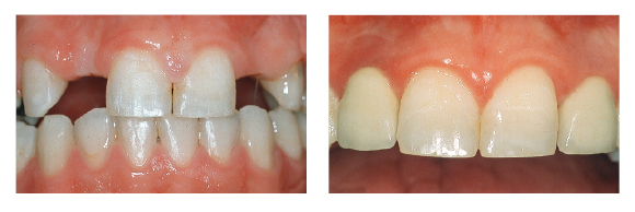 Figg. 27a e 27b Sorriso di un paziente con agenesia di 1.2 e 2.2 in cui sono stati aperti con un trattamento ortodontico gli spazi per una successiva riabilitazione implantoprotesica.