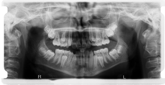 Fig. 1 Ortopantomografia delle arcate dentarie, esame che ci permette una visione generale della situazione odontoiatrica del paziente.