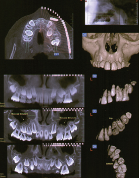 Fig. 11 L’utilizzo della CBCT può essere un valido ausilio in alcuni casi ortodontici complessi, come ad esempio in presenza di canini ritenuti che necessitano di disinclusione chirurgica o di essere estratti.