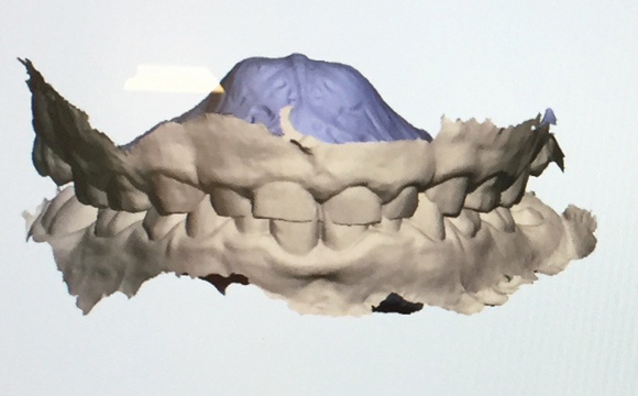 Fig. 11a Il futuro dell’ortodonzia: i digital cast, strumento che andrà sempre più a sostituirsi alle classiche impronte in gesso grazie anche all’accuratezza e alla precisione dei nuovi mezzi che abbiamo oggi a disposizione. 