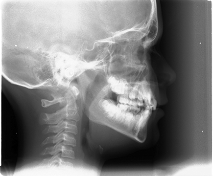 Fig. 2 Teleradiografia latero-laterale del cranio, esame di primaria importanza nella valutazione ortodontica del paziente.
