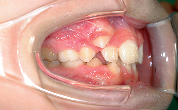 Fig. 7 Foto laterale intraorale destra, in cui si può valutare la classe molare e canina del paziente; si nota il canino in eruzione ectopica.
