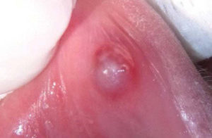 Fig. 1 Lesione tondeggiante di circa 1 cm di diametro; la mucosa che la ricopre appare integra e di colorito traslucido, i margini sono iperemici e non ispessiti; è fluttuante alla palpazione.