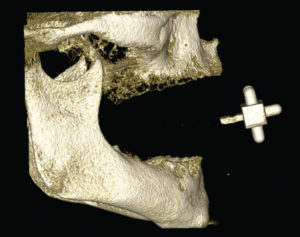 Fig. 3 La ricostruzione 3D del massiccio faciale edentulo evidenzia la presenza del repere extraorale applicato alla protesi durante l’esame. L’anatomia chirurgica visualizzata attraverso l’elaborazione del software 3Diagnosys v4.1 (3Diemme, Italia) permette di realizzare con precisione il progetto implantare virtuale in 3D. 