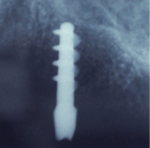 Fig. 6 La radiografia della vite appena inserita.