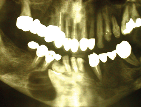 Fig. 1 Radiografia ortopanoramica preoperatoria.