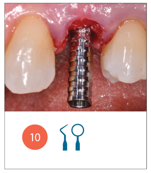 Fig. 10 Si inserisce il moncone provvisorio con connessione interna, si riprova il provvisorio e lo si ribasa direttamente in bocca con resina acrilica antimicrobica. 