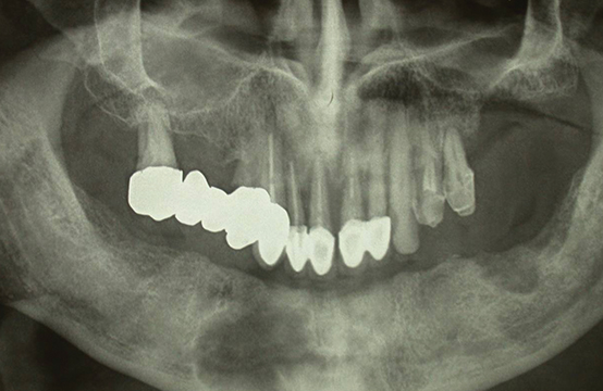 Fig. 13 Ortopantomografia dopo 3 mesi.