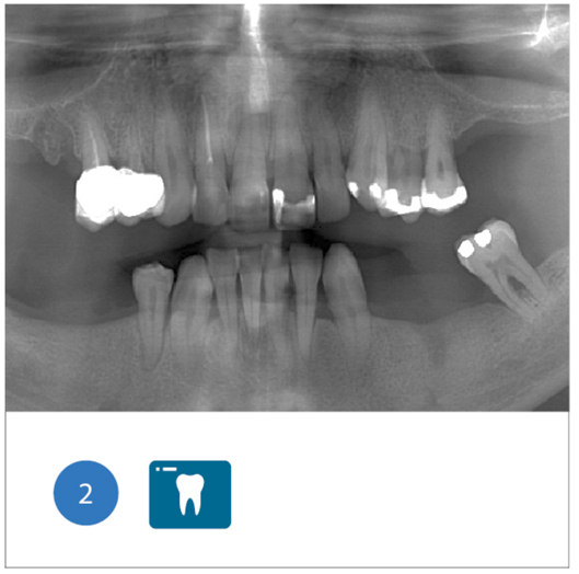 Fig. 2 Ortopanoramica iniziale del paziente dove si evidenziano le sofferenze parodontali