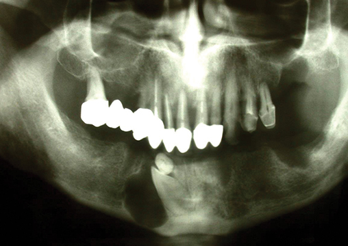 Fig. 3 Ortopantomografia dopo bonifica dentaria.