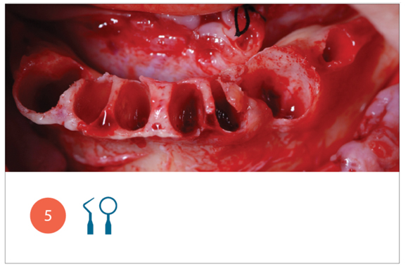 Fig. 5 Avulsione degli elementi dentari e scheletrizzazione ossea. 