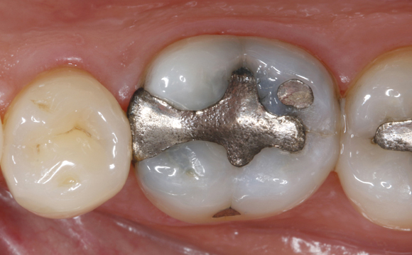 Fig. 1 Condizione prima del trattamento: otturazione in amalgama nel dente 46.