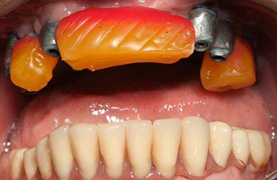 Fig. 17 Cera di masticazione per il rilevamento dell’occlusione nel cavo orale.