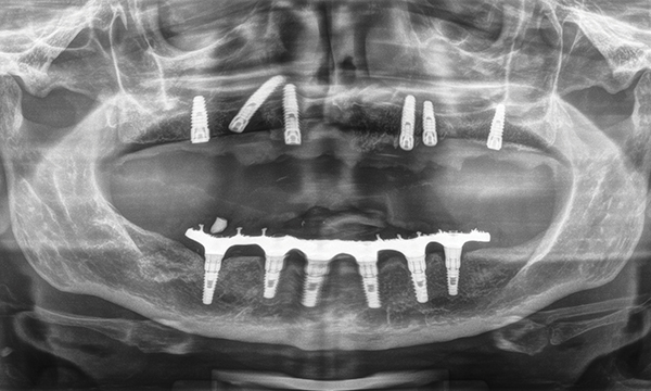 Fig. 2 Ortopantomografia iniziale.