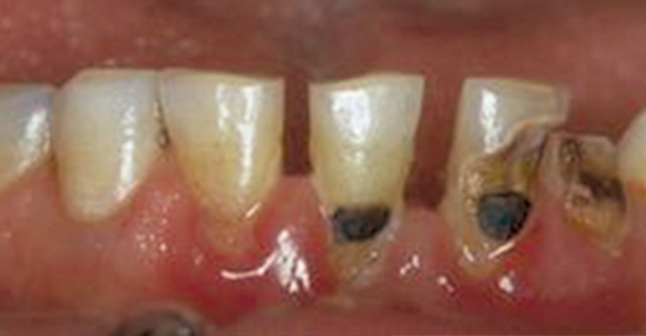 Fig. 4 Evoluzione della carie: da “white spot” alla dentina.