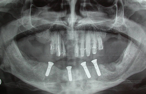 Fig. 16 Ortopantomografia dopo chirurgia implantare.