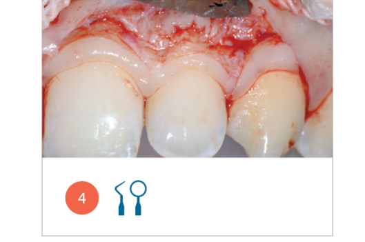 Fig. 4 Elevazione a spessore totale del lembo primario, con mantenimento in situ del lembo secondario. Si nota il marcato spessore della cresta ossea e la sua vicinanza alla linea amelo-cementizia degli elementi dentari di sinistra. 