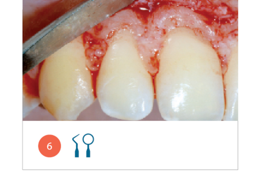Fig. 6 Osteoplastica e ostectomia, per ricreare una giusta distanza della cresta ossea dalla linea amelo-cementizia delle corone dentarie di destra.
