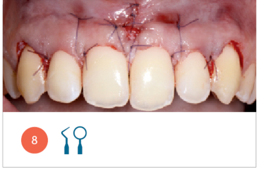 Fig. 8 Suture a materassaio verticale esterno e suture semplici per stabilizzare il lembo all’altezza della linea amelo-cementizia degli elementi dentari.