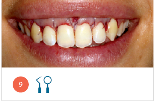 Fig. 9 Sorriso della paziente alla fine della chirurgia di allungamento di corona clinica.