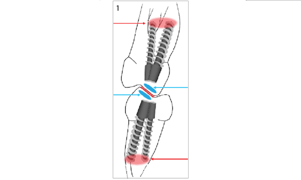Fig. 1 Le frecce blu ad indicare la superficie occlusale di carico dei molari. Le frecce rosse la maggior area in cui si scaricano le stesse forze occlusali.