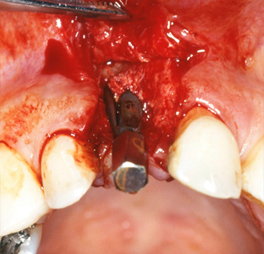 Fig. 15 La perdita spontanea del dente.