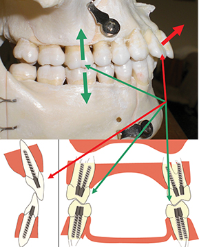 Fig. 23 Frecce rosse ad evidenziare la diversa inclinazione dei denti frontali in confronto all’inclinazione delle radici dei premolari e molari (frecce verdi).