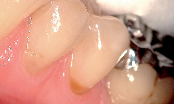 Dente 35 con difetto al colletto dentale