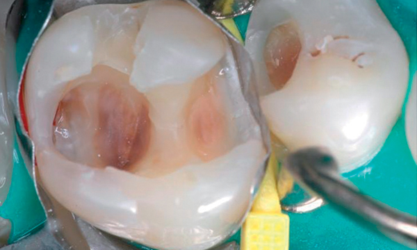 Caso di dolore: denti 16, 15 dopo l’escavazione