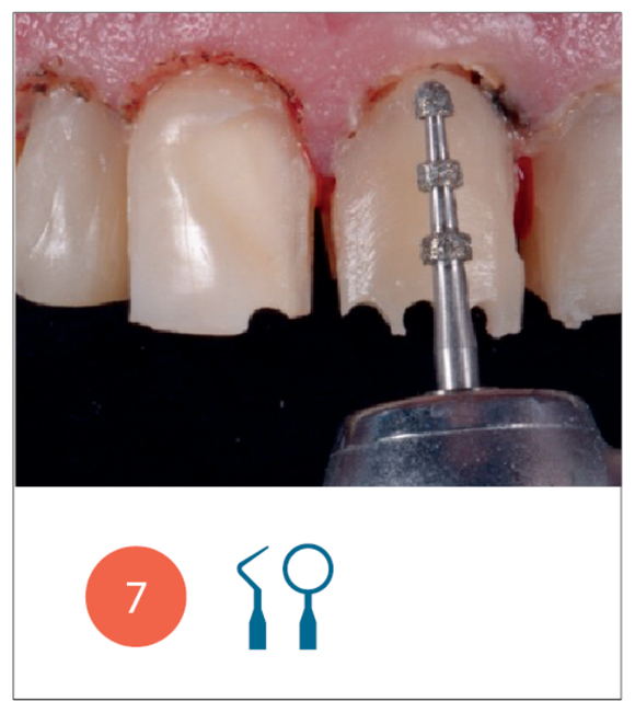 Fase di preparazione degli elementi dentari eseguita con metodica mininvasiva