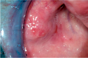 Fig. 1 Mucosa geniena di destra prima dell’intervento.