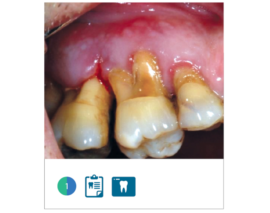 Fig. 1 Situazione clinica iniziale: gli elementi presentano una compromissione parodontale tale da richiederne l’estrazione.