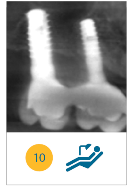 Fig. 10 A 6 anni dal carico gli impianti mostrano radiograficamente una buona qualità dei tessuti circostanti.