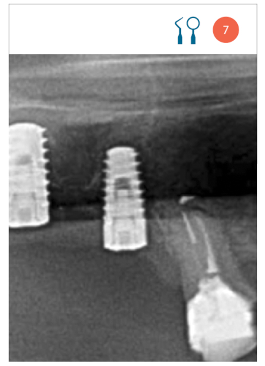 Fig. 7 Radiograficamente gli impianti non appaiono circondati da tessuti duri. 