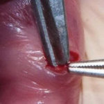 Fig. 5 Con l’ausilio di una pinzetta chirurgica e di una forbice a punte smusse si esegue la delicata dissezione del sottile epitelio che ricopre la lesione.