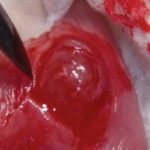 Fig. 6 Scollato l’epitelio che la ricopre viene evidenziata nella sua interezza la parete superficiale della lesione.