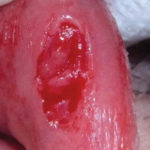 Fig. 8 La lesione va asportata totalmente insieme con il tessuto perilesionale costituito dagli acini ghiandolari dai quali trae origine.