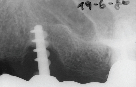 Fig. 13 La radiografia sottolinea l’aumentato riassorbimento osseo attorno alle due prime spire dell’impianto. Questo cono di riassorbimento si è in seguito risolto spontaneamente per apposizione ossea dopo l’inserimento della nuova protesi definitiva.