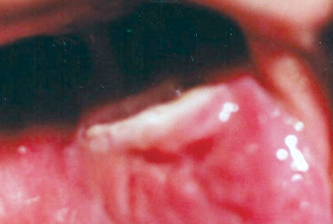 papilloma labbro inferiore