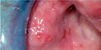 Fig. 1 Mucosa geniena di destra prima dell’intervento.