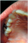 Fig. 3A Black stain: prima del trattamento con compresse orosolubili contenenti 50 mg di lattoferrina.