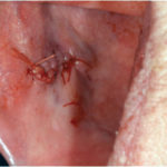 Fig. 5 La ferita chirurgica suturata con filo 4/0 riassorbibile.