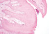 Fig. 11 Neoformazione fibroepiteliale con visibili due assi rivestiti da epitelio pavimentoso composto paracheratosico. Da notare le angiectasie negli assi fibroepiteliali, la papillomatosi del corion e l’acantosi con approfondimento delle creste interpapillari dell’epitelio di rivestimento. Colorazione con Ematossilina-Eosina, ingrandimento 50x.