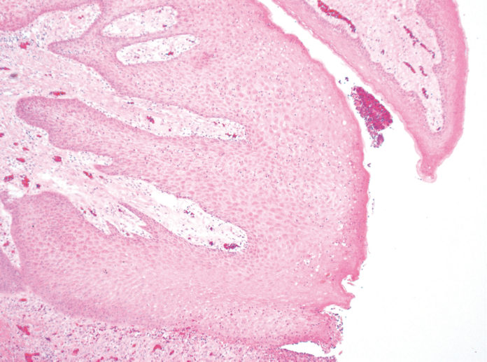 Fig. 11 Neoformazione fibroepiteliale con visibili due assi rivestiti da epitelio pavimentoso composto paracheratosico. Da notare le angiectasie negli assi fibroepiteliali, la papillomatosi del corion e l’acantosi con approfondimento delle creste interpapillari dell’epitelio di rivestimento. Colorazione con Ematossilina-Eosina, ingrandimento 50x.
