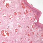Fig. 12 Notare le angiectasie del corion. Il rivestimento epiteliale superficiale in questo tratto risulta appiattito e composto da una decina di strati. Colorazione con Ematossilina-Eosina, ingrandimento 100x.